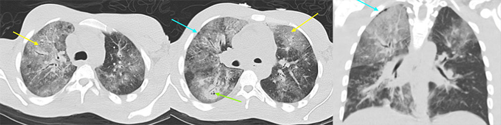 38 year old male with recently diagnosed and untreated HIV with fever and cough