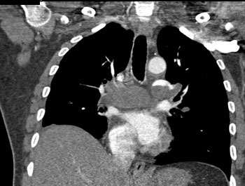 cardiac 64 mdct