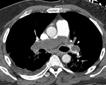 cardiac 64 mdct