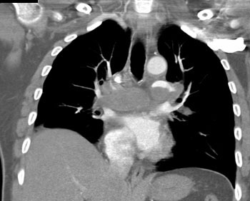 cardiac 64 mdct