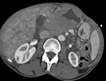 cardiac 64 mdct