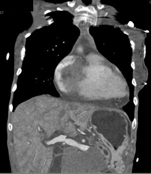 cardiac 64 mdct