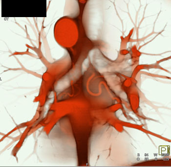 cardiac 64 mdct