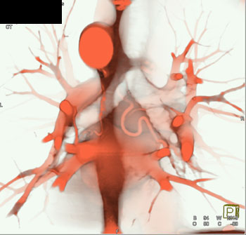 cardiac 64 mdct