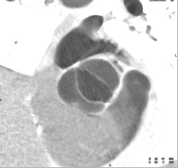 cardiac 64 mdct