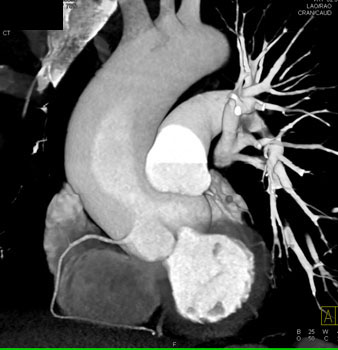 cardiac 64 mdct