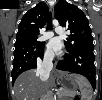cardiac 64 mdct