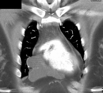 cardiac 64 mdct