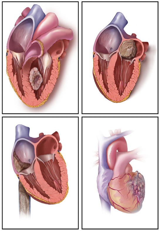 Cardiac Masses