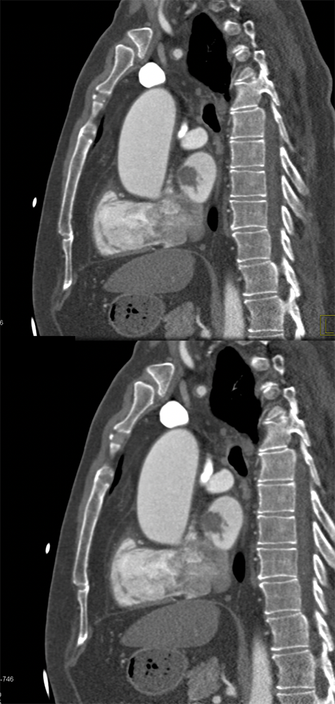 Left Atrial Myxoma