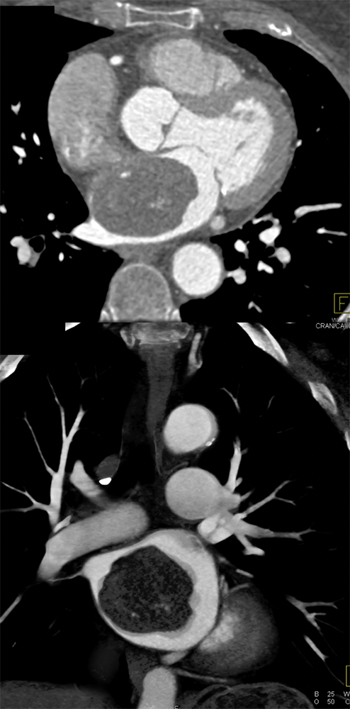 Atrial Myxoma