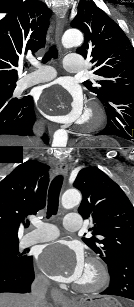 Atrial Myxoma