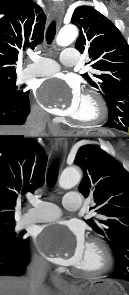 Atrial Myxoma
