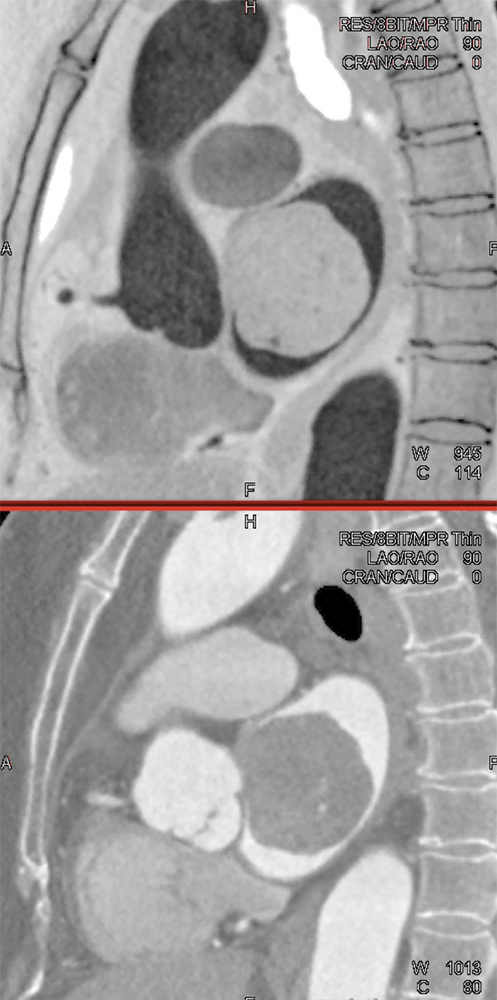 Atrial Myxoma