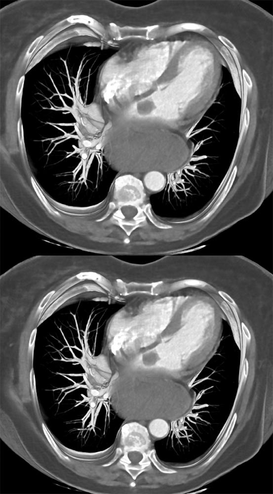 Left Atrial Myxoma