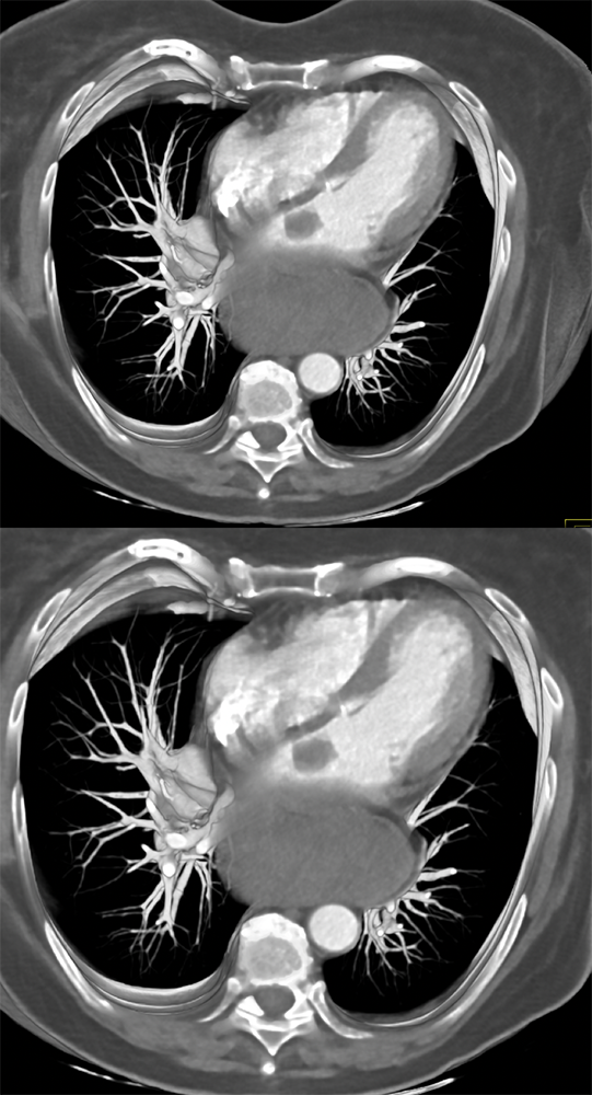Left Atrial Myxoma