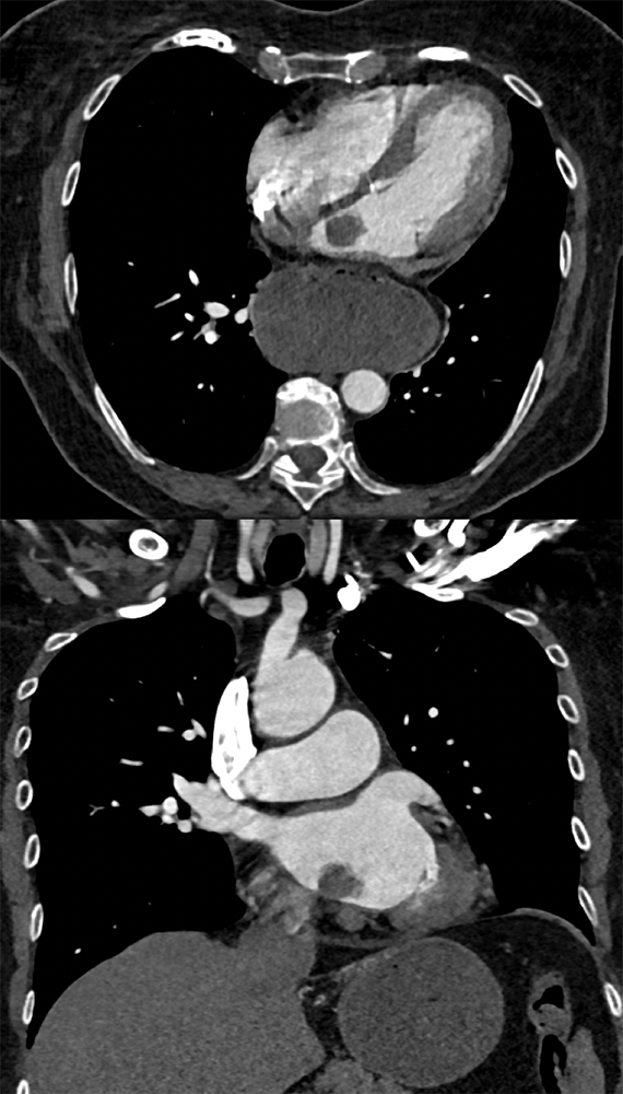 Left Atrial Myxoma