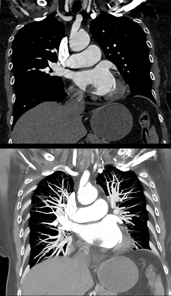 Left Atrial Myxoma