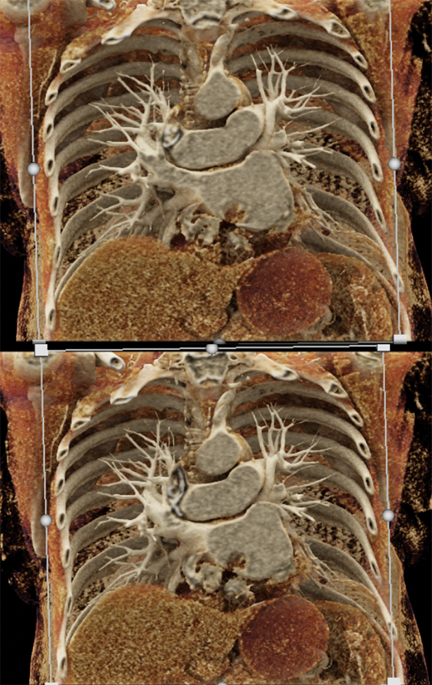 Left Atrial Myxoma