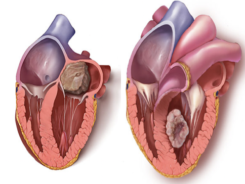 Intracavitary Mass Differential Diagnosis