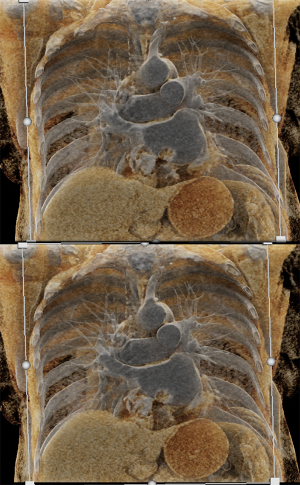 Left Atrial Myxoma