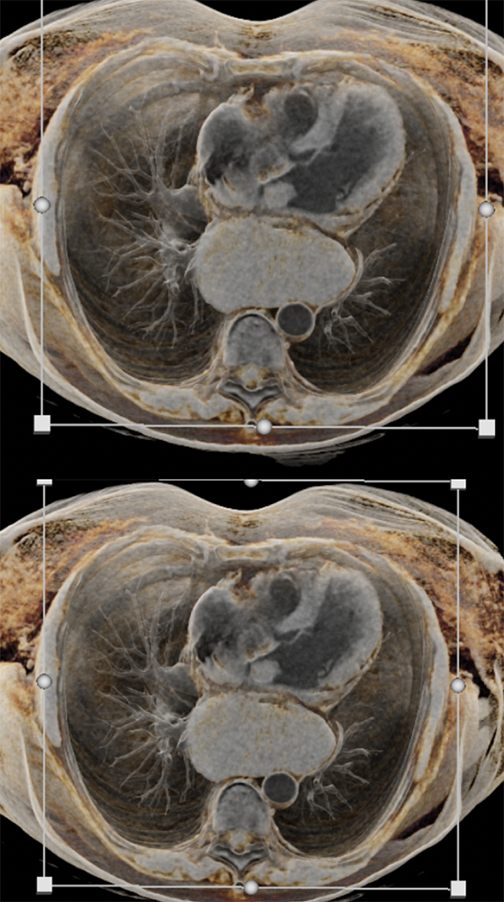 Left Atrial Myxoma