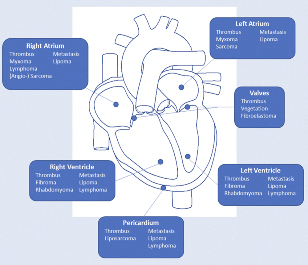 Cardiac Masses