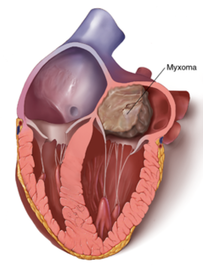Cardiac Masses