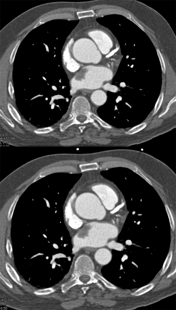 Left Atrial Myxoma
