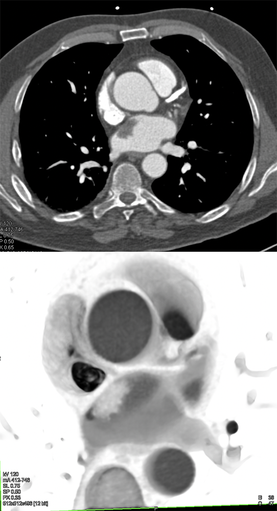 Left Atrial Myxoma