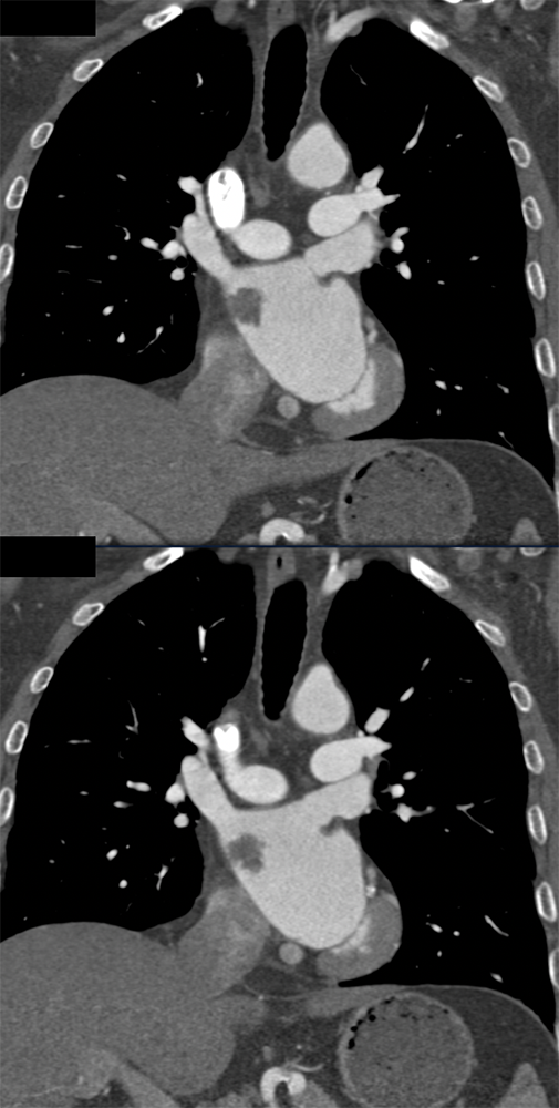 Left Atrial Myxoma
