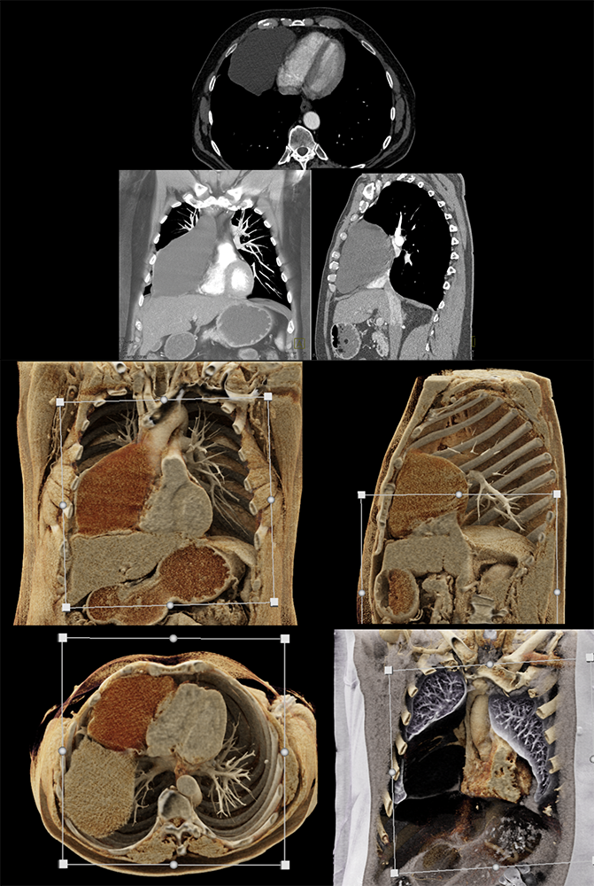 Benign pericardial cyst
