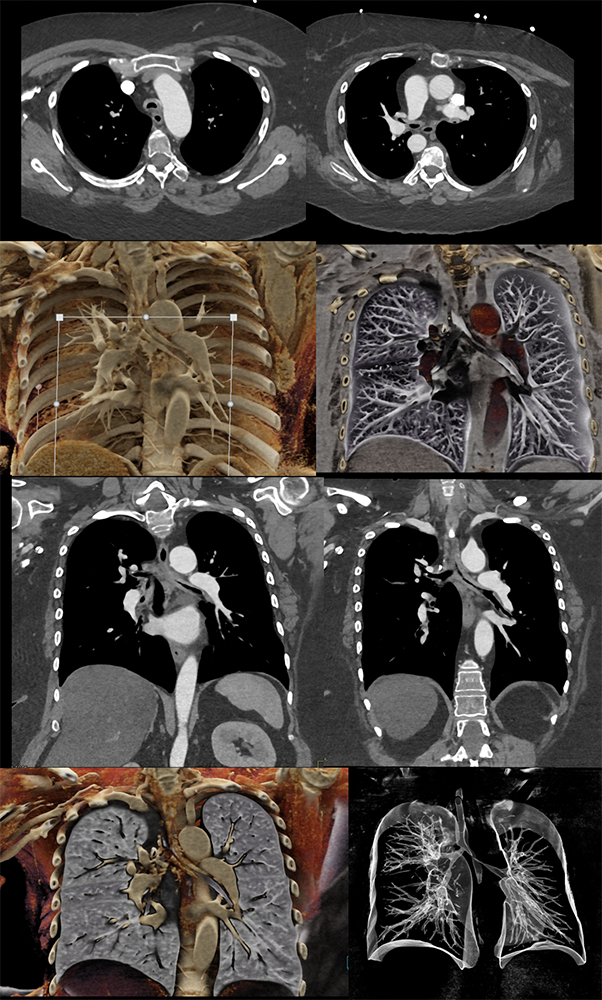 Relapsing polychondritis