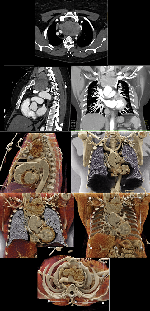 Thymoma