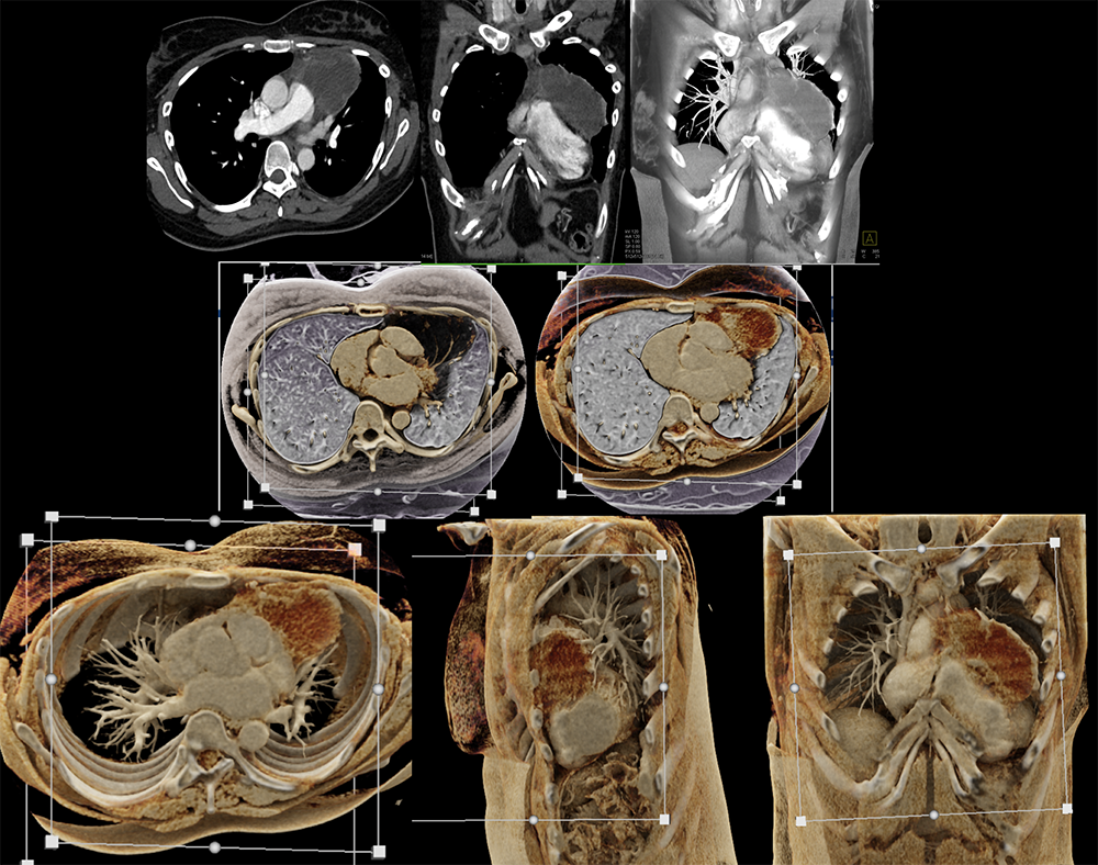 Cystic thymoma