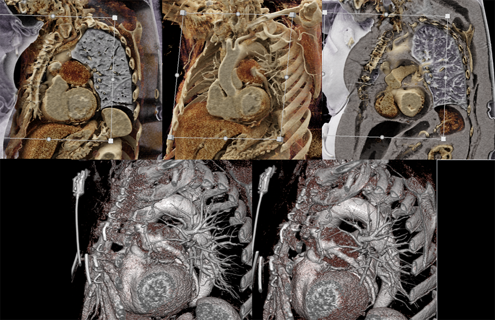 Cinematic Rendering of Mediastinal Pathology