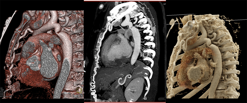 Cinematic Rendering of Mediastinal Pathology