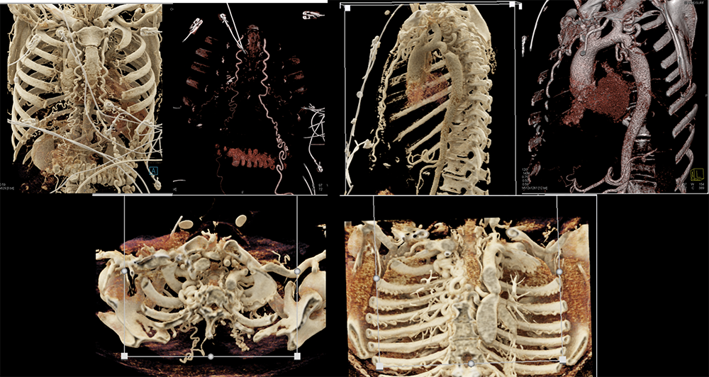 Coarctation of Aorta with Collaterals