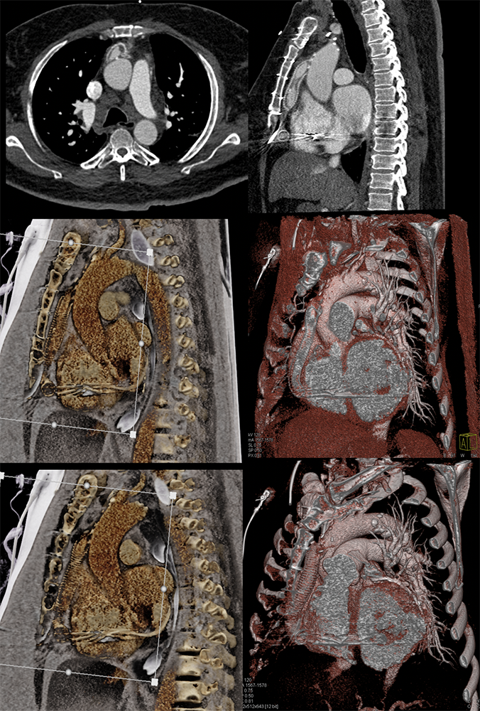 LVAD outflow obstruction