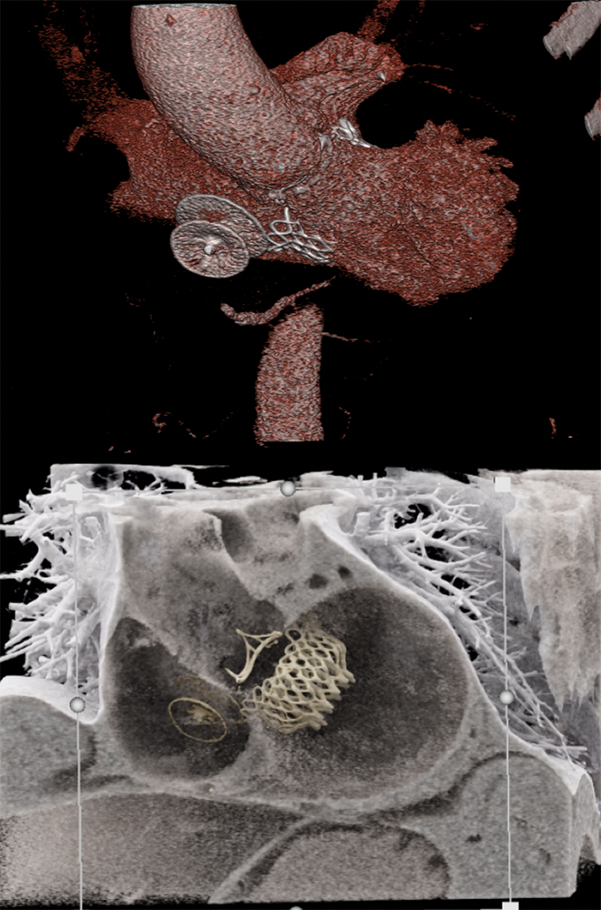 Cinematic Rendering of Mediastinal Pathology