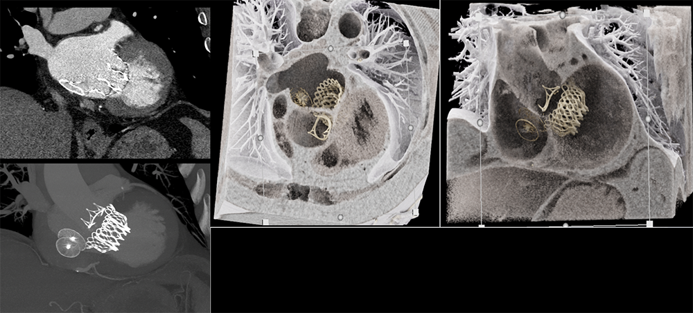Post TMVR (trans-catheter mitral valve replacement)