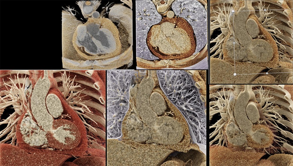 Pericarditis