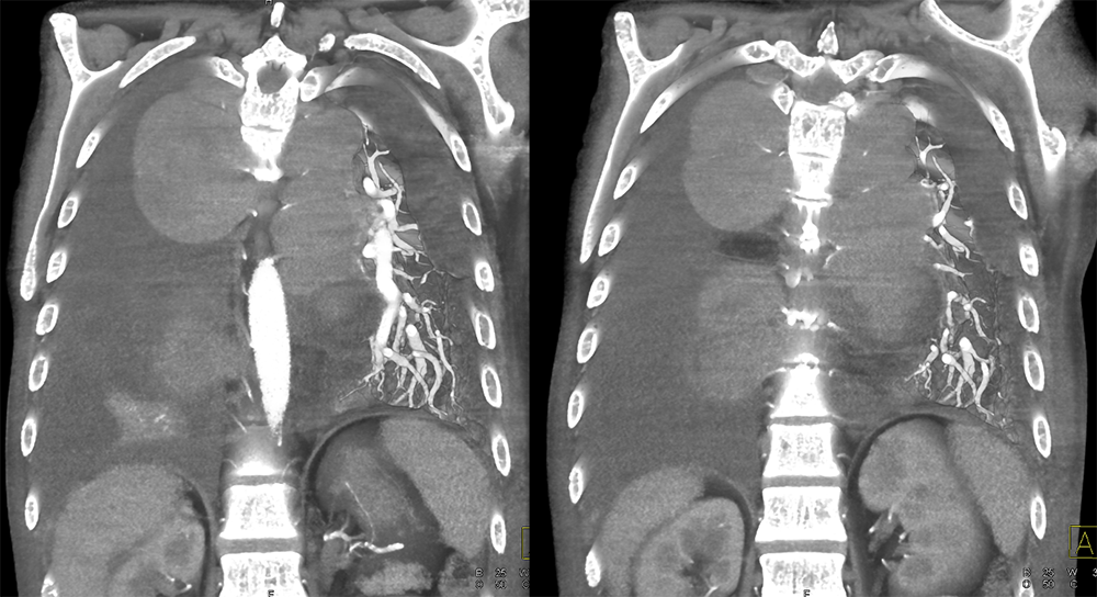 Mediastinal Widening on CXR