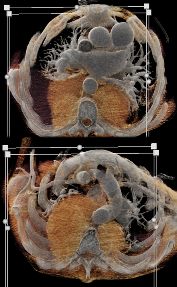 Mediastinal Widening on CXR
