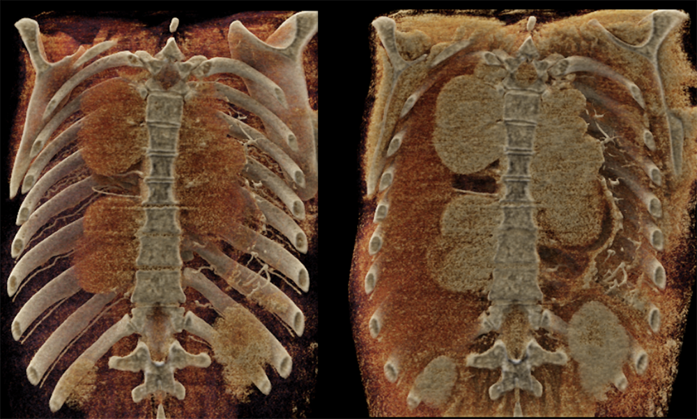 Mediastinal Widening on CXR