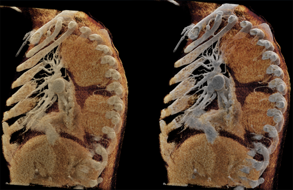 Mediastinal Widening on CXR