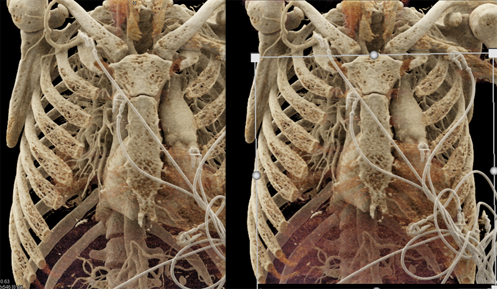 Mediastinal Widening on CXR