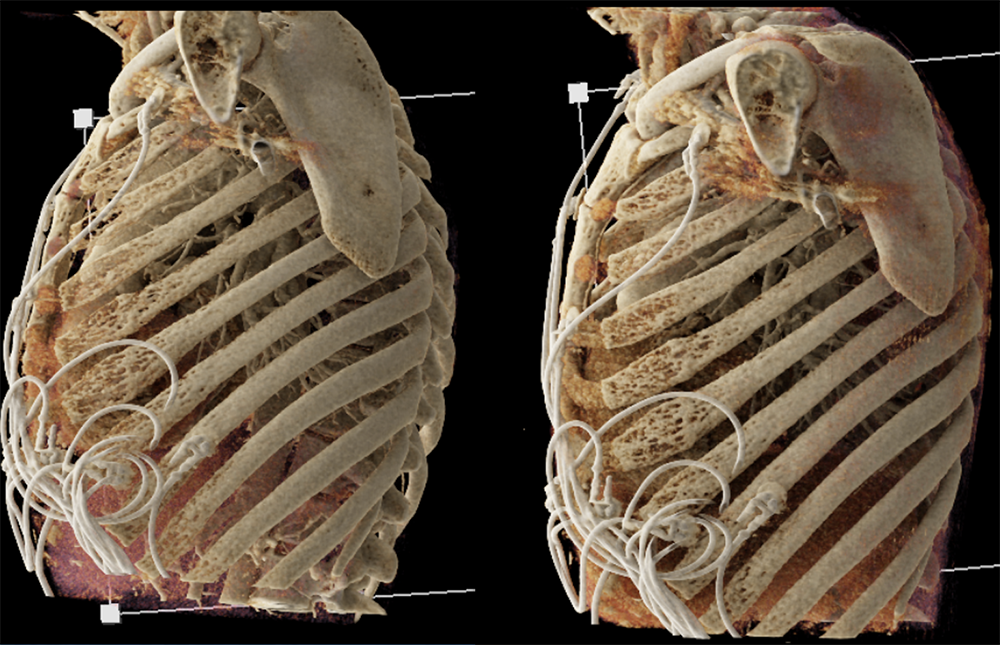 Mediastinal Widening on CXR