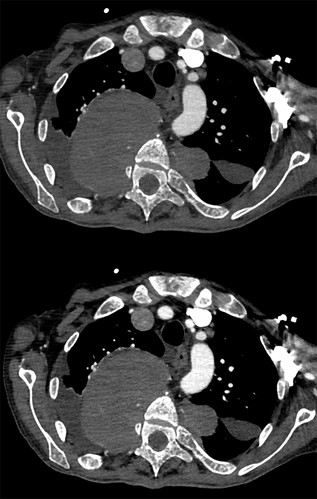 Beta Thalassemia with Extramedullary Hematopoiesis