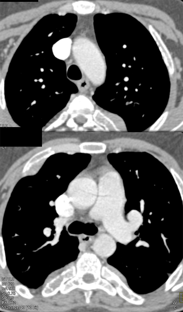 Mediastinum
